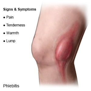 Phlebitis