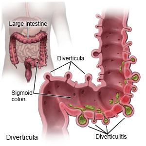 Diverticula