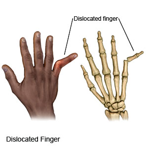 Dislocated Finger