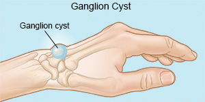 Ganglion Cyst